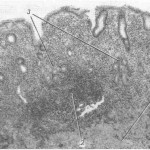 слизистая оболочка больного атрофическим гастритом