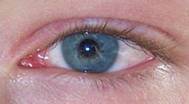 Pinkeye