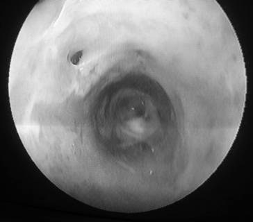 C:\Users\Ярема ИВ\Documents\КАФЕДРА\Диссертанты\ПАНОВА\эндоскопия полости матки\IMG_1160.jpg