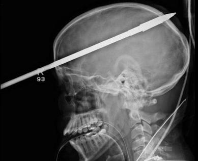 C:\Documents and Settings\Юра\Local Settings\Temporary Internet Files\Content.Word\рана головы.jpg