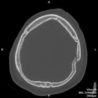 C:\Documents and Settings\Юра\Рабочий стол\300 тестов\перелом теменных костей.jpeg