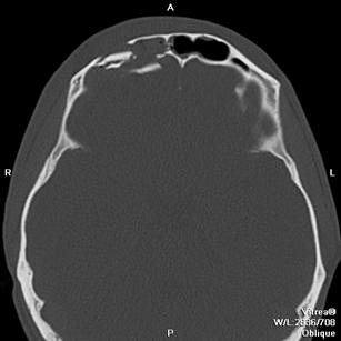 C:\Documents and Settings\Юра\Рабочий стол\300 тестов\перелом лобной кости.jpeg