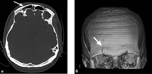 C:\Documents and Settings\Юра\Рабочий стол\300 тестов\перелом верхней стенки глазницы.jpg