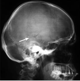 C:\Documents and Settings\Юра\Рабочий стол\300 тестов\перелом височной кости.jpg