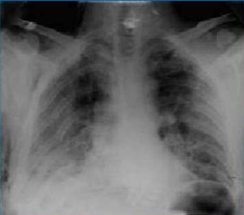 C:\Documents and Settings\Юра\Local Settings\Temporary Internet Files\Content.Word\двусторонний множественный перелом ребер.jpg