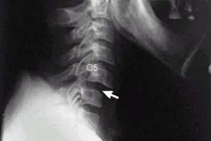 C:\Documents and Settings\Юра\Рабочий стол\300 тестов\вывих шейного позвонка.jpg