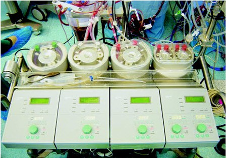 Аппарат искусственного кровообращения (АИК)